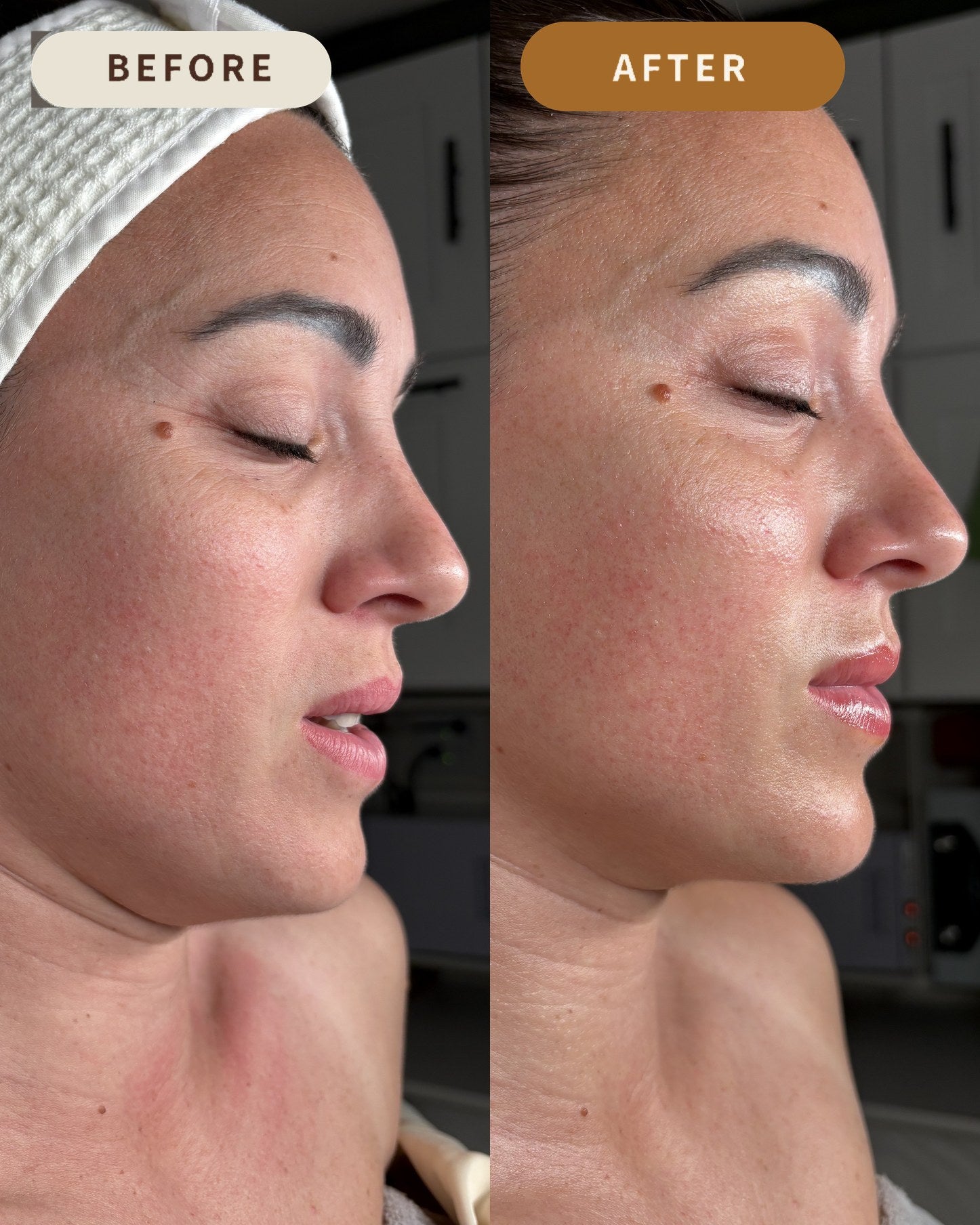Before and after profile comparison showing smoother, more hydrated skin following treatment