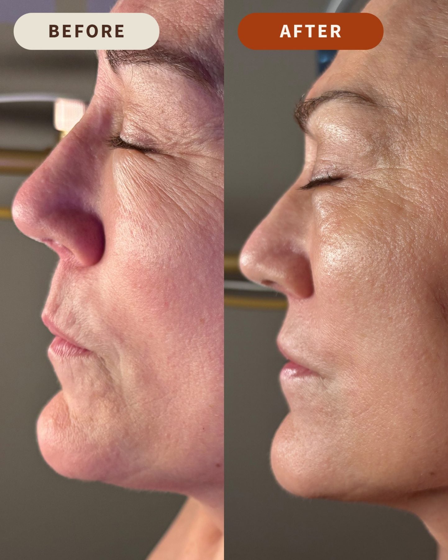 Client before and after treatment, profile view